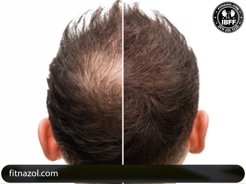 پروویرون و ریزش مو